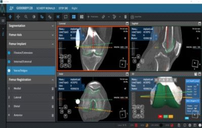 Cuvis Joint - Personalized Pre Planning