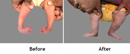 Pediatric Orthopedic Surgery - Club Foot