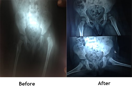 Pediatric Orthopedic Surgery - DDH (Hip Dislocation)