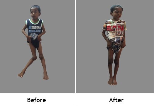 Pediatric Orthopedic Surgery - Genu Valgum and Genu Varum