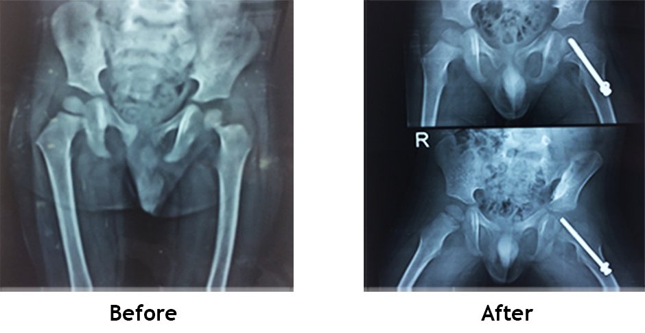 Paediatric fracture (Trauma)