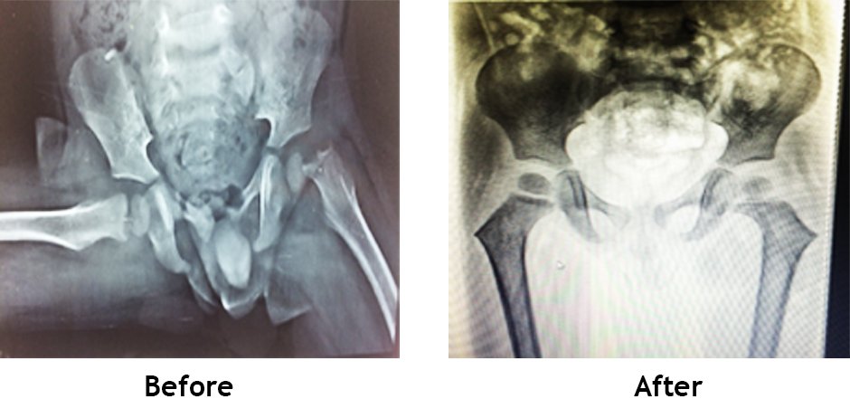 Paediatric fracture (Trauma)