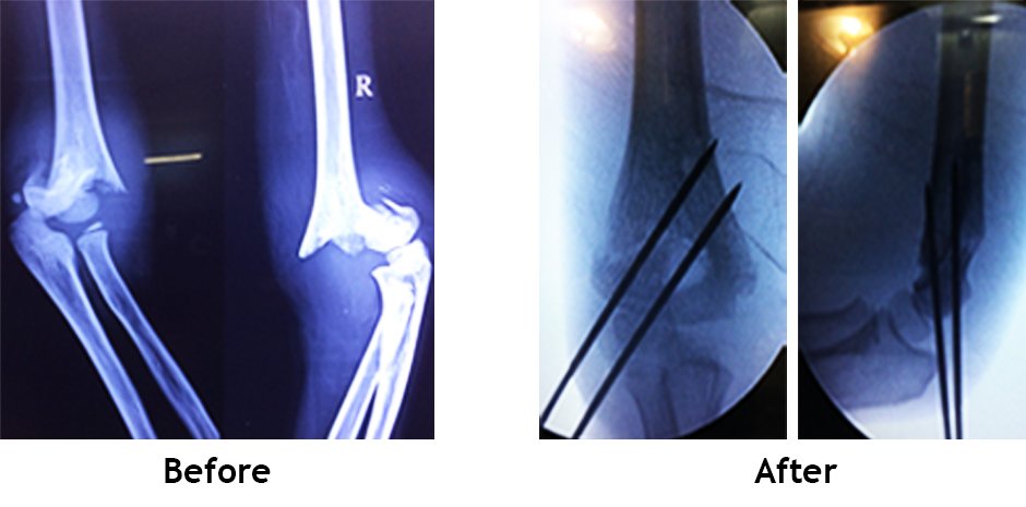 Paediatric fracture (Trauma)