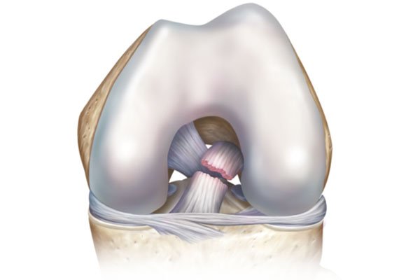 Sports Medicine & Arthroscopy - ACL Injury