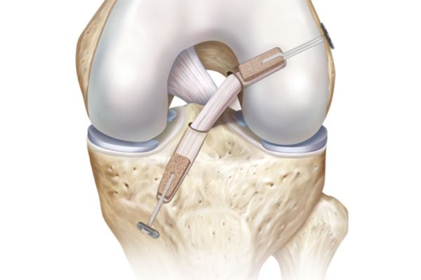 Sports Medicine & Arthroscopy - ACL Injury