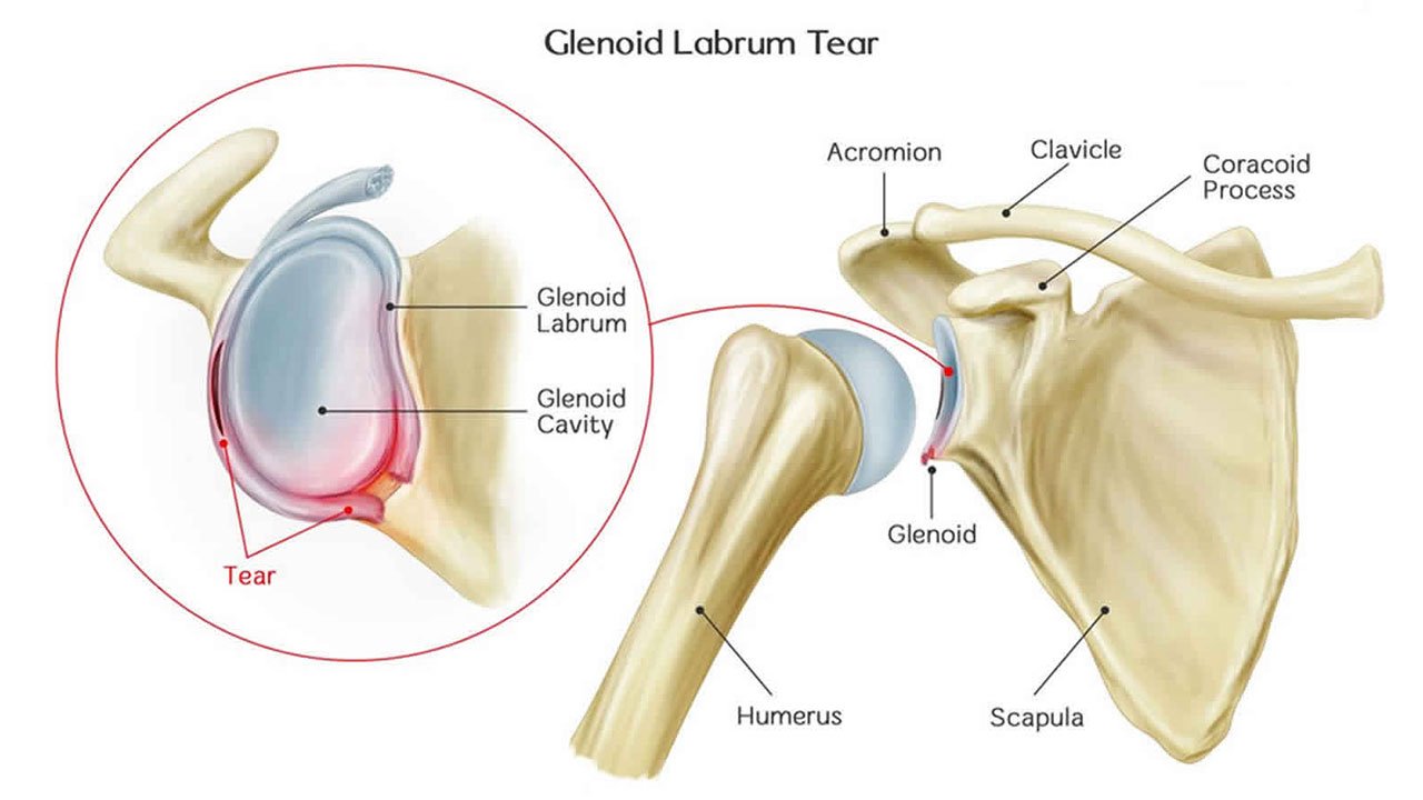 Sports Medicine & Arthroscopy - Bankart Lesion Before Surgery