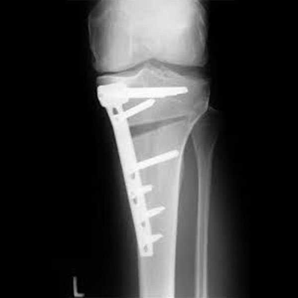 High Tibial Osteotomy Surgery