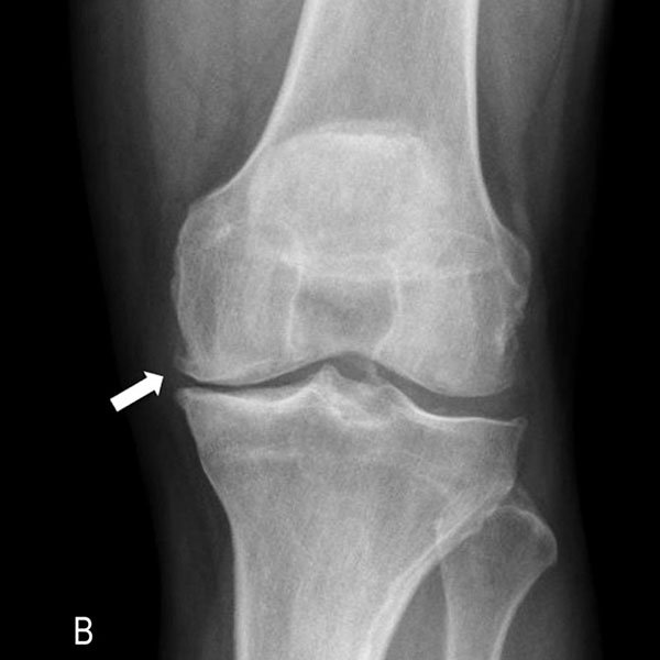 High Tibial Osteotomy Surgery