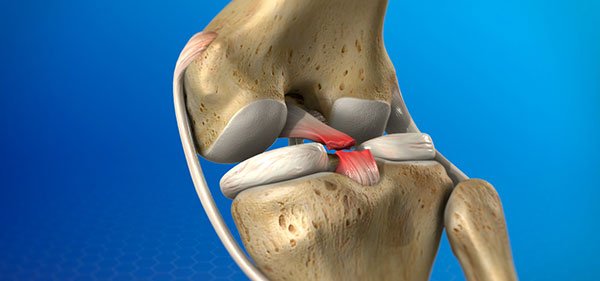 Sports Medicine & Arthroscopy - PCL Reconstruction