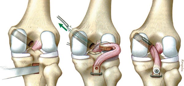 Sports Medicine & Arthroscopy - PCL Reconstruction