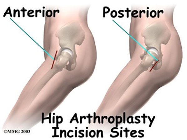 Total Knee Replacement Surgery